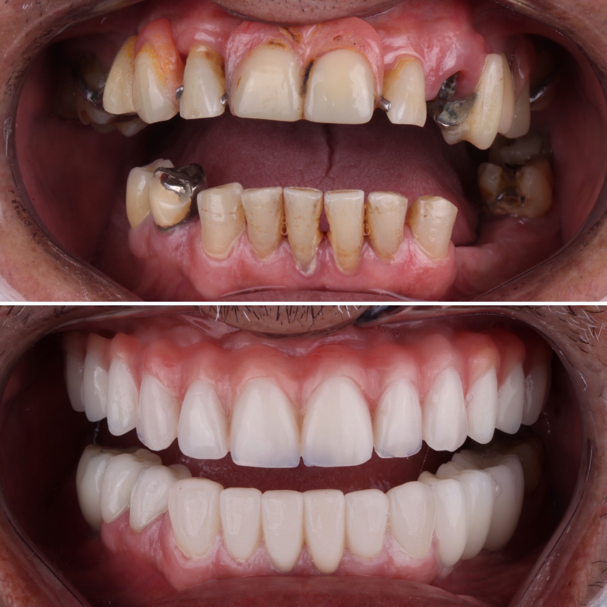 Substituicao-de-resinas-antigas-por-novas-lentes-em-ceramica.jpg